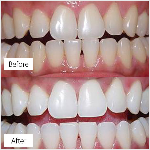 سفید کردن دندان با لیزر-دکتر وحید پورصادق