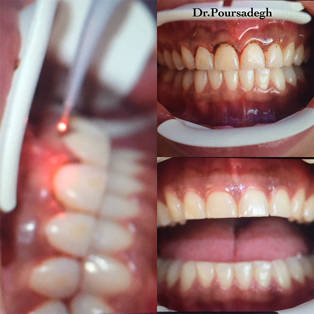 Gingivectomy - Dr Vahid Poursadegh