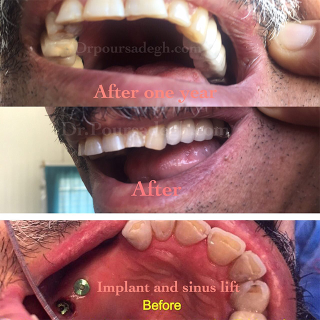 Implant - Dr Vahid Poursadegh